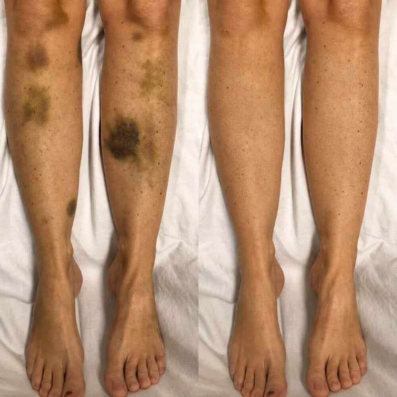 Je cachais mes jambes à cause des bleus très vi...